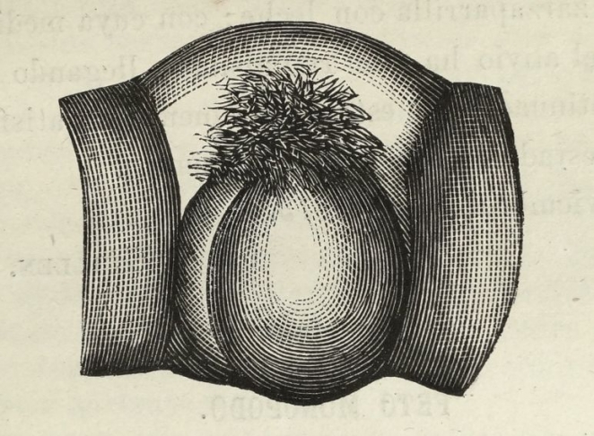 Hidrocele
