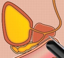 biopsia de próstata ecodirigida băi cu radon prostatita