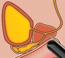 Fusion biopsy pentru diagnosticul cancerului de prostată