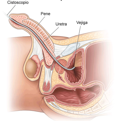 Citoscopia. Uretra, próstata y vejiga