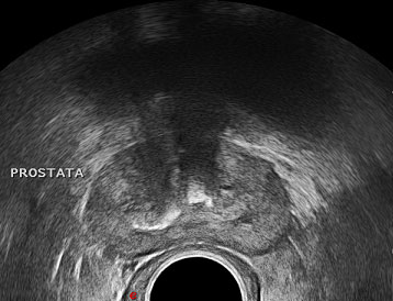 ecografía prostática transrectal)