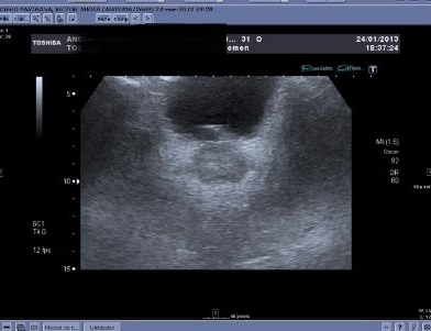 ecografia prostata brățară bianshi prostatita