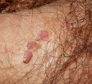 Virus papiloma humano, verruga genital plana