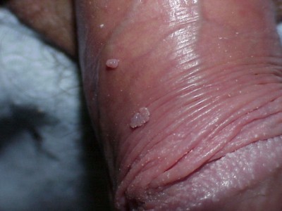 Verrugas genitales en la piel del pene