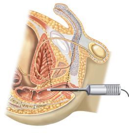 Zona anatómica de trabajo del transductor rectal