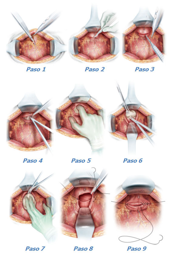 Tratament de chirurgie oncologie adenom de prostată