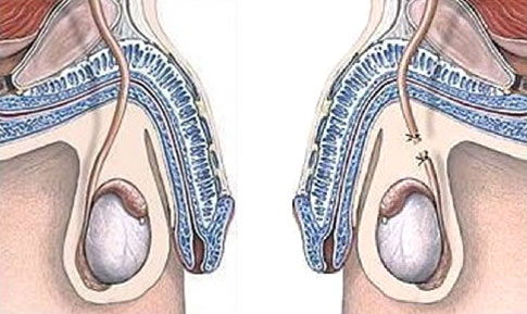 vazectomia és prostatitis