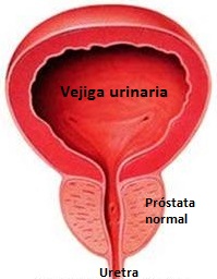 prostatita urinara