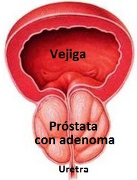 Próstata con adenoma. Se aprecia el conducto urinario o uretra comprimido y elongado, debido al crecimiento del adenoma