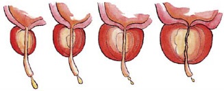 Crecimiento del adenoma de próstata con la edad y disminución progresiva del flujo urinario