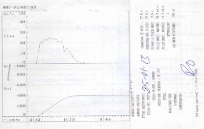 Registro en papel de una flujometría con una curva de micción normal. Registro obtenido en el flujómetro del Hospital Civil (Carlos Haya)