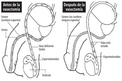 vasectomía en urología