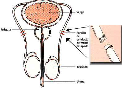 vazectomia és prostatitis