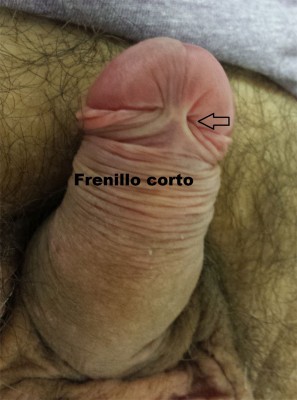 Frenillo corto