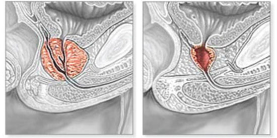 Próstata antes y después de RTU