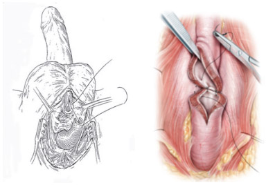 uretroplastia

Es utilizado para la estenosis y para divertículos ureterales