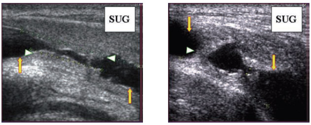Figura 3: Imagen ecográfica de estenosis de uretra