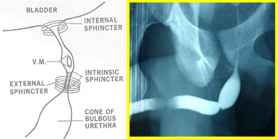 Figura 3: Partes anatómicas de la uretra y su equivalencia con la imagen radiológica de uretrografía
