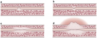 Figura 4: Grados de estenosis de la uretra:  a. pliegue de la mucosa; b. estenosis en forma de iris; c. Compromiso completo con fibrosis mínima del tejido esponjoso; d. Espongiofibrosis total