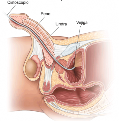 Figura 4.- Partes de la anatomía que evalúa una cistoscopia en el hombre. En este caso observamos cómo pasa por uretra (pene), próstata y vejiga.