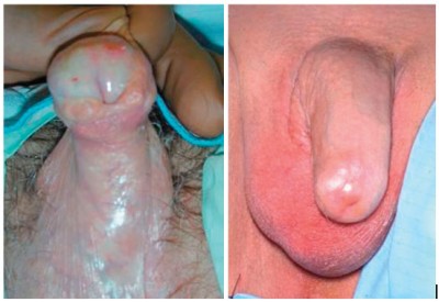 Figura 8: Apariencia clínica del Liquen Escleroatrófico. En la imagen de la izquierda aparece edema y ulceración del glande. En la imagen de la derecha se aprecia fusión del prepucio al glande en un paciente no circuncidado.