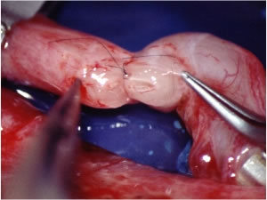 Aproximación previa de los extremos proximal y abdominal del conducto deferente en el momento de iniciar la sutura
