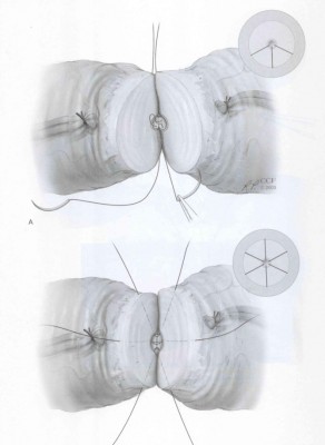 Aproximación y manera de dar la sutura del conducto deferente en ambos extremos