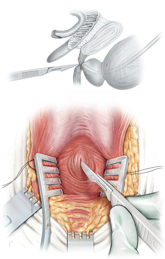 prostatectomía procedimiento quirúrgico
