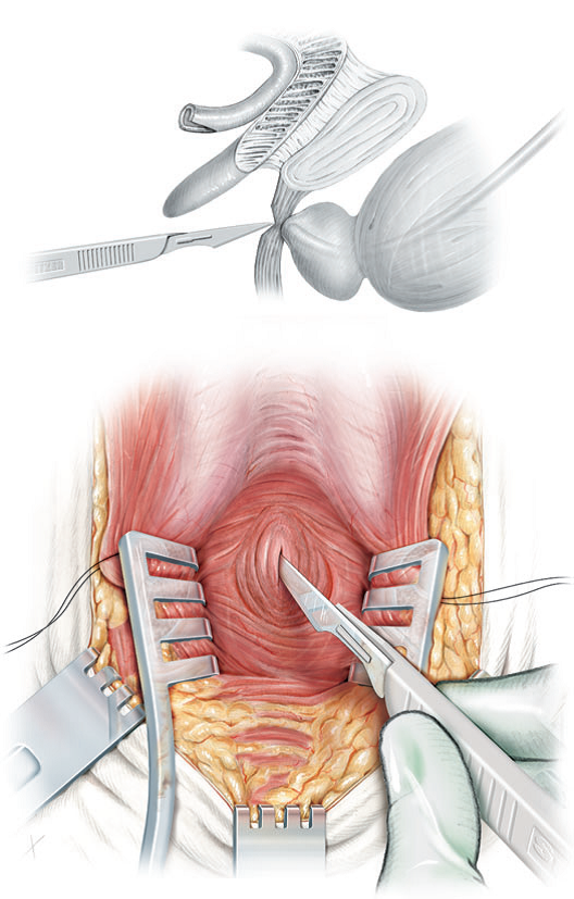 Tratament de chirurgie oncologie adenom de prostată