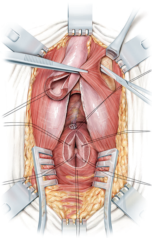 Movilización de la uretra bulbar y exposición del pubis tras la pubectomía