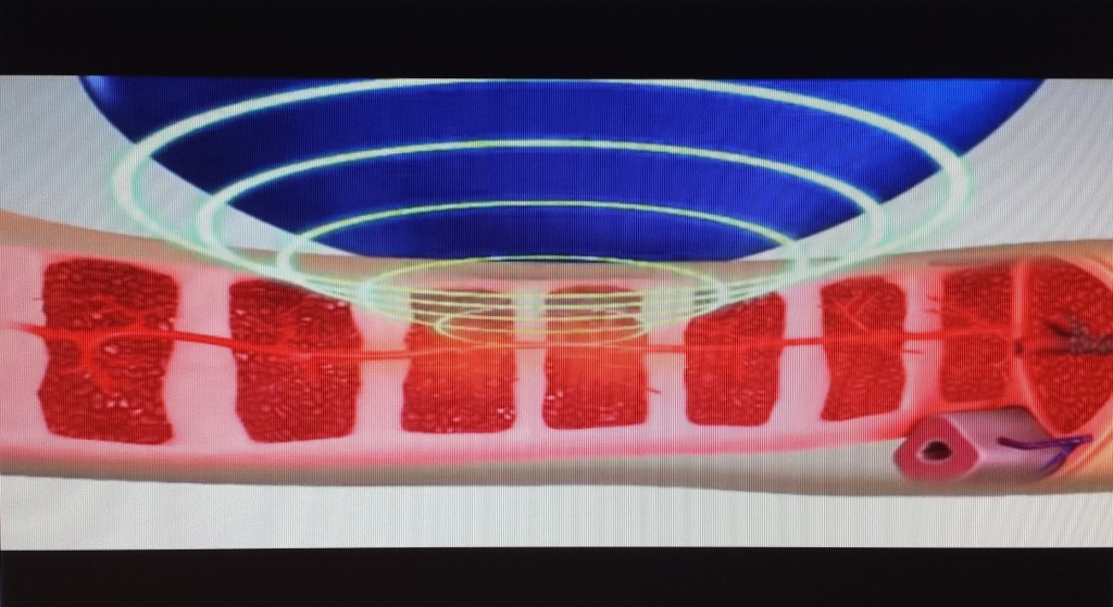 Esquema o dibujo donde se aprecia como las ondas van aplicándose en profundidad sobre las arterias milimétricas del pene