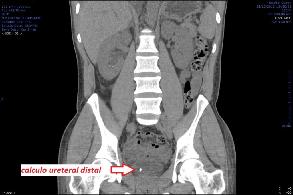 Figura 8.- UroTAC: Imágenes de TAC sin contraste donde se aprecia litiasis ureteral distal derecha