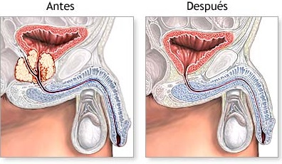 próstata y disfunción eréctil acolo unde doareprostată
