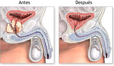 próstata y disfunción eréctil