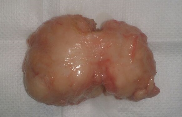prostata con adenoma bilobato anatomía zonal de la próstata