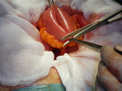 Cirugía reconstructiva de una neovejiga tipo Hautmann con intestino delgado realizada en el Hospital Civil de Málaga en el año 2009