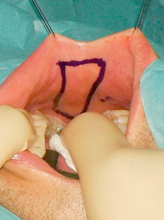 Estenosis de uretra