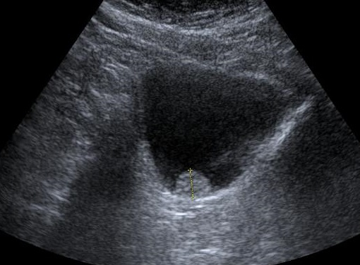 Imagen ecográfica de la vejiga con lesión compatible con cáncer urotelia de vejiga en la base