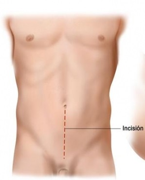 Incisión que se realiza en el abdomen para realizar la extirpación de la vejiga