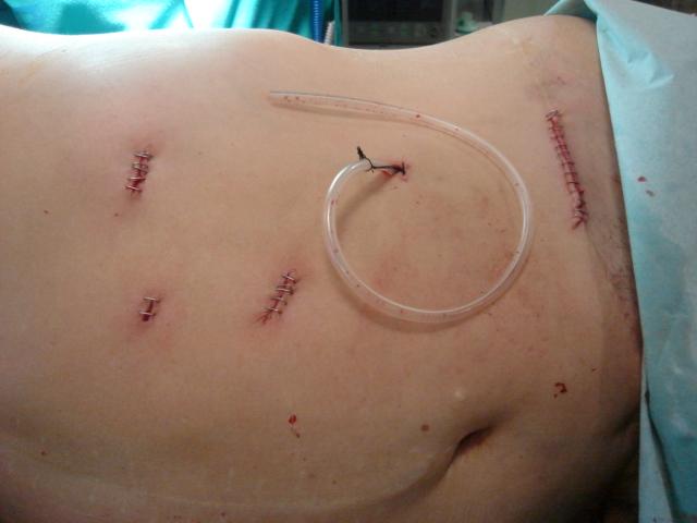 Aspecto del abdomen de un paciente tras una nefrectomía
