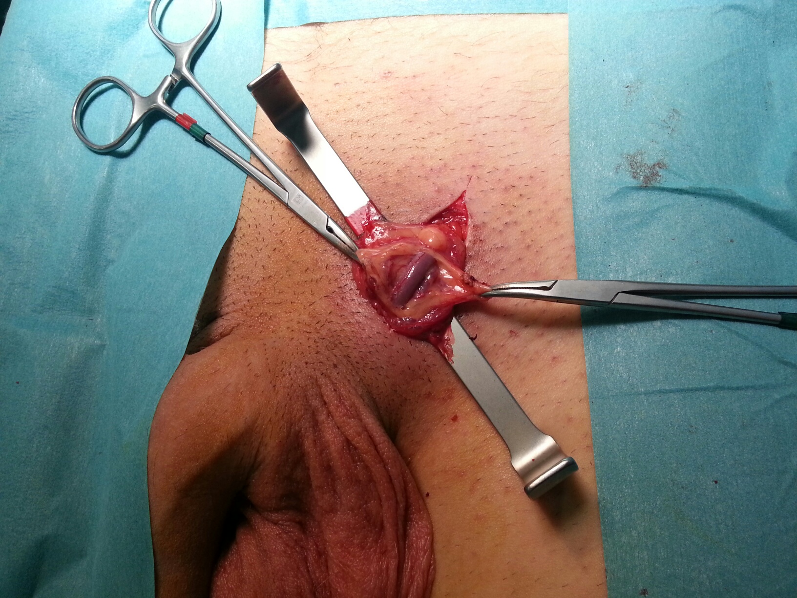 Imagen de operación de varicocele