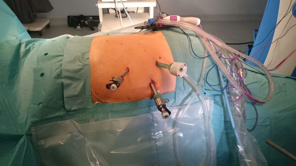 Imagen del abdomen de un paciente en quirófano 