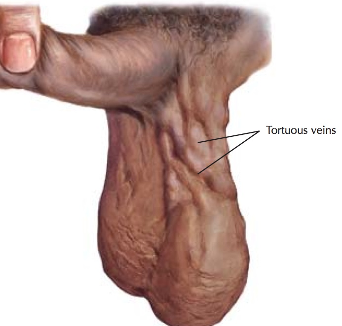 Varicocele grado III