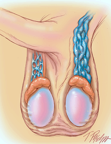 Varicocele izquierdo