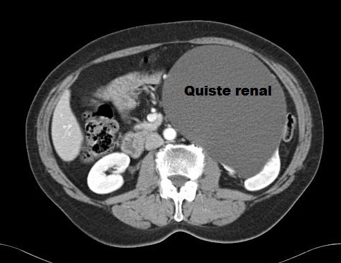 quiste renal