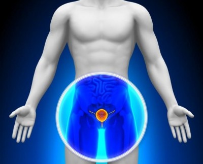 cancer de prostata diagnostico