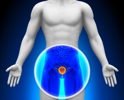 Prostatitis inflamatoria asintomática