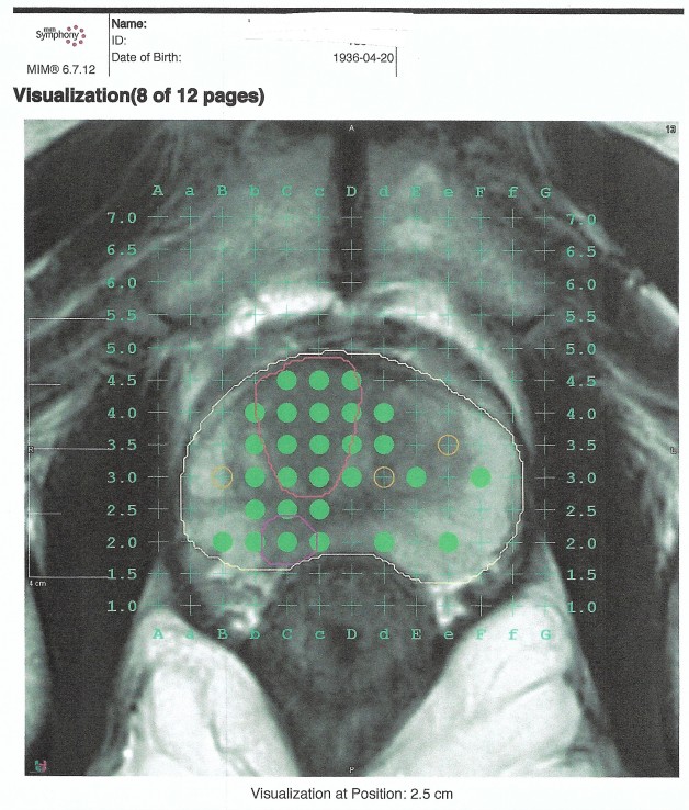 Rmn multiparametrica de prostata codigo