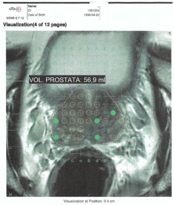 biopsia de próstata por el perineo)