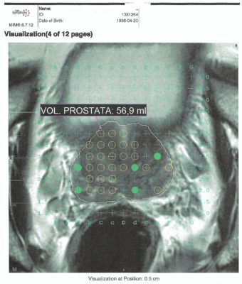 Cancer de prostata imagenes reales